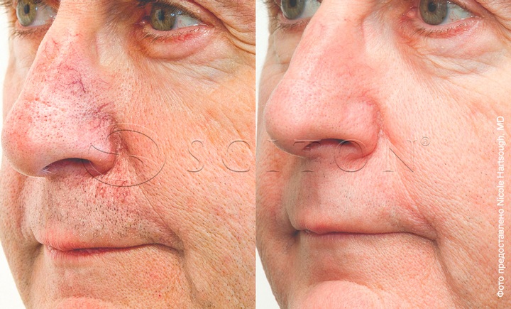 Купероз на носу фото до и после процедур BBL Sciton