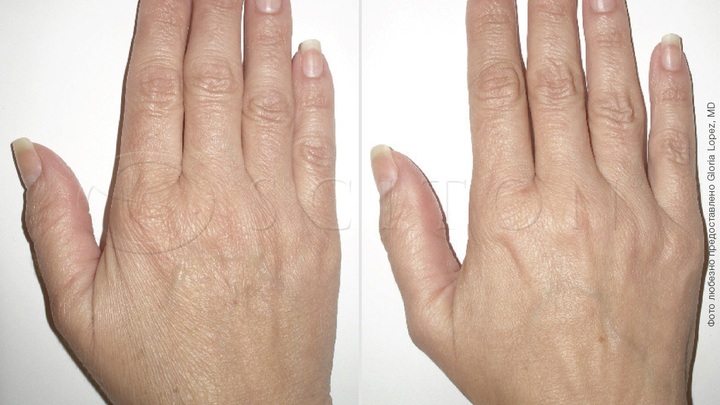 Ліфтинг шкіри рук SkinTyte II системою BBL Sciton