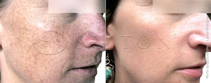 Фотостаріння шкіри - пігментація обличчя